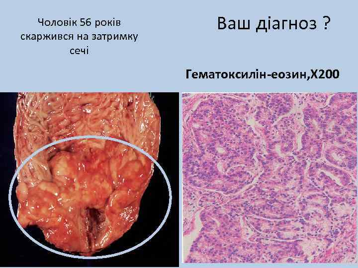 Чоловік 56 років скаржився на затримку сечі Ваш діагноз ? Гематоксилін-еозин, Х 200 