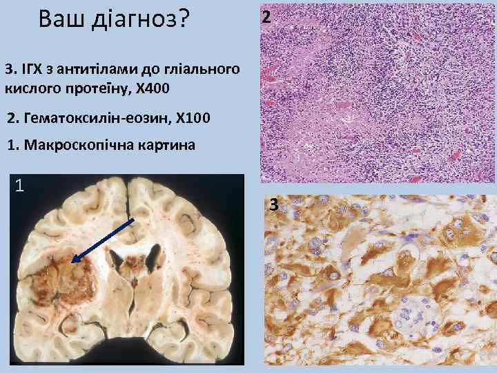 Ваш діагноз? 2 3. ІГХ з антитілами до гліального кислого протеїну, Х 400 2.