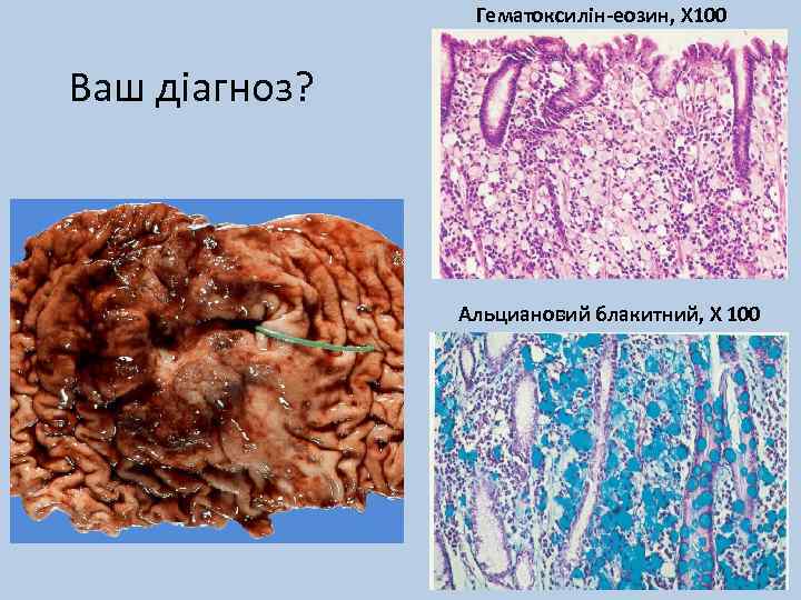 Гематоксилін-еозин, Х 100 Ваш діагноз? Альциановий блакитний, Х 100 