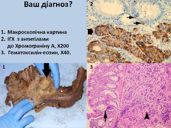 Ваш діагноз? 2 1. Макроскопічна картина 2. ІГХ з антитілами до Хромограніну А, Х