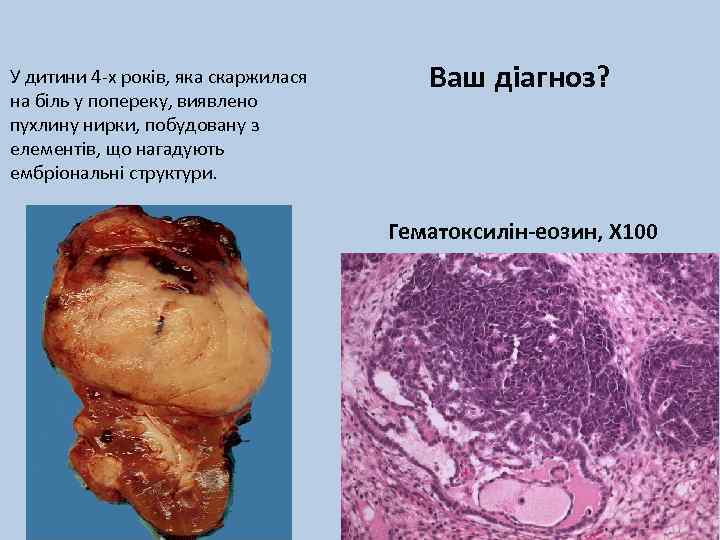 У дитини 4 -х років, яка скаржилася на біль у попереку, виявлено пухлину нирки,