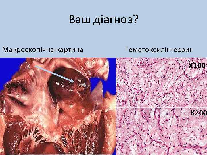 Ваш діагноз? Макроскопічна картина Гематоксилін-еозин Х 100 Х 200 