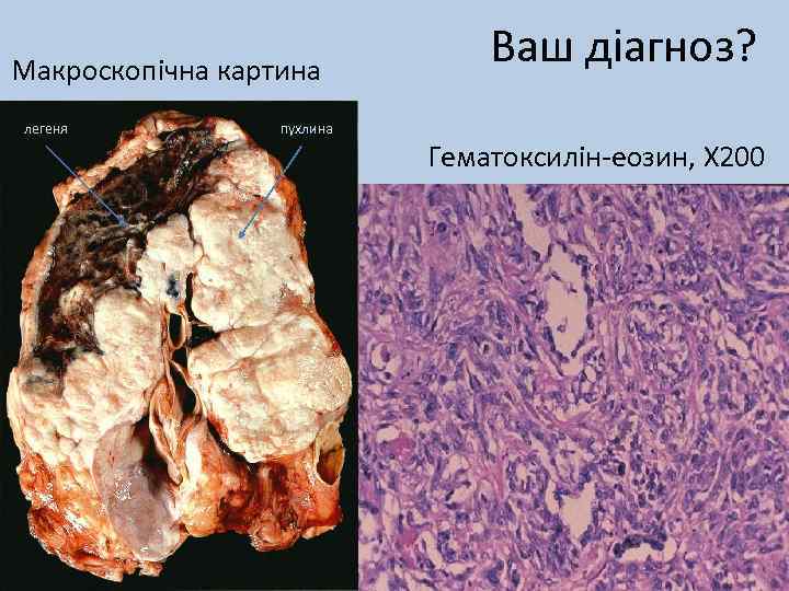Макроскопічна картина легеня пухлина Ваш діагноз? Гематоксилін-еозин, Х 200 
