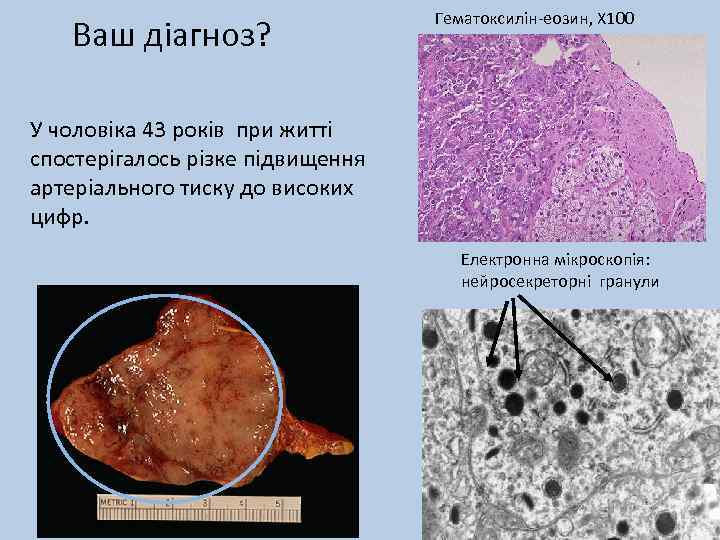 Ваш діагноз? Гематоксилін-еозин, Х 100 У чоловіка 43 років при житті спостерігалось різке підвищення