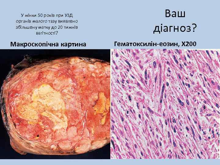 У жінки 50 років при УЗД органів малого тазу виявлено збільшену матку до 20