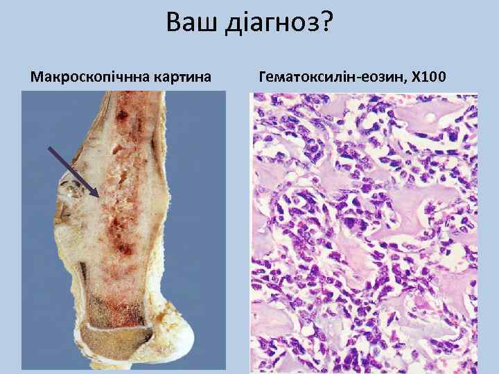 Ваш діагноз? Макроскопічнна картина Гематоксилін-еозин, Х 100 