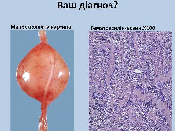 Ваш діагноз? Макроскопічна картина Гематоксилін-еозин, Х 100 