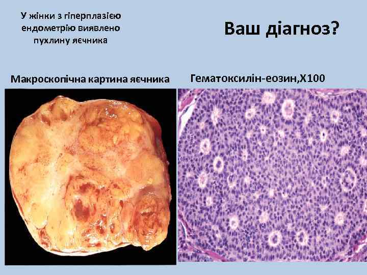 У жінки з гіперплазією ендометрію виявлено пухлину яєчника Макроскопічна картина яєчника Ваш діагноз? Гематоксилін-еозин,