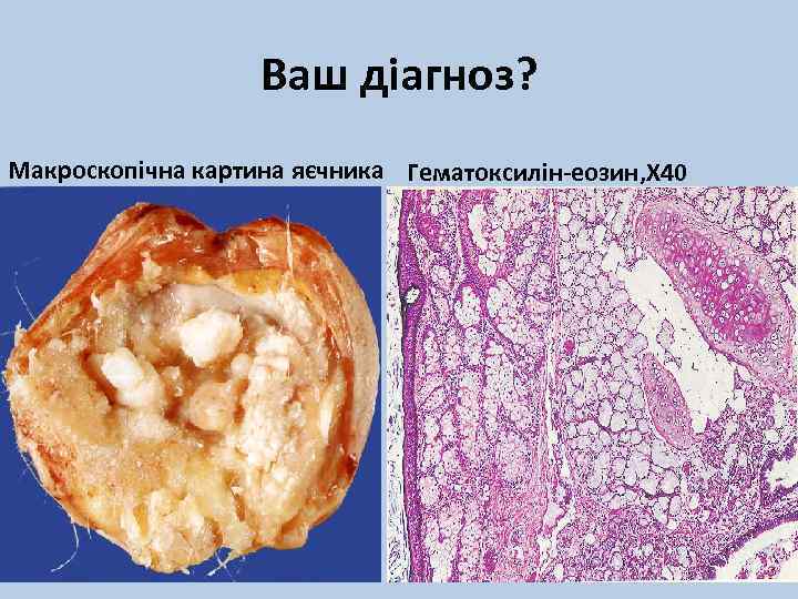 Ваш діагноз? Макроскопічна картина яєчника Гематоксилін-еозин, Х 40 