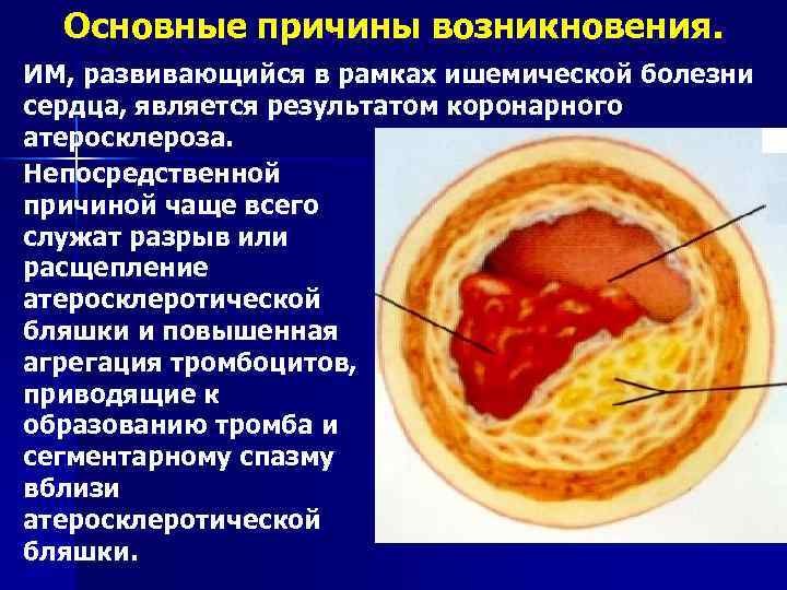 Атеросклероз причины