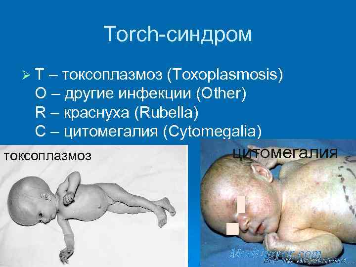 Torch-синдром Ø T – токсоплазмоз (Тoxoplasmоsis) О – другие инфекции (Оther) R – краснуха