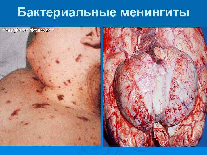 Бактериальные менингиты 