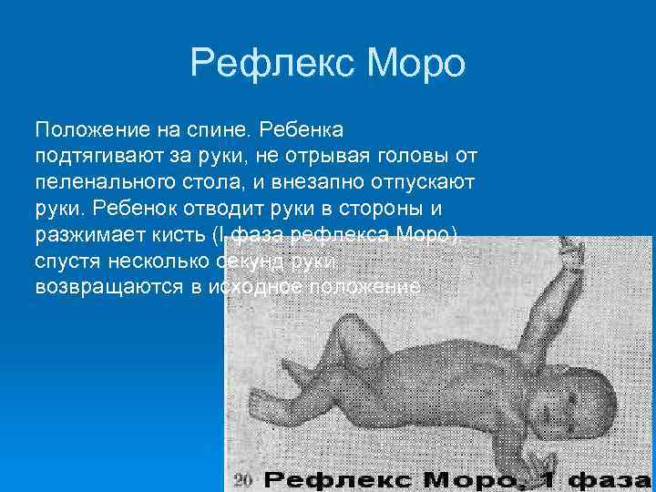 Рефлекс Моро Положение на спине. Ребенка подтягивают за руки, не отрывая головы от пеленального