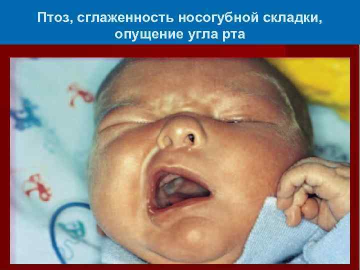 Птоз, сглаженность носогубной складки, опущение угла рта 