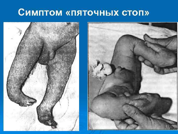 Симптом «пяточных стоп» 