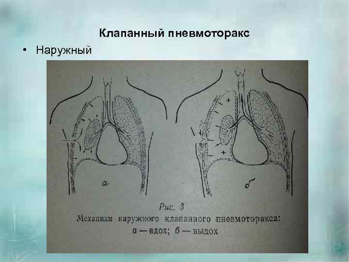 Клапанный пневмоторакс • Наружный 