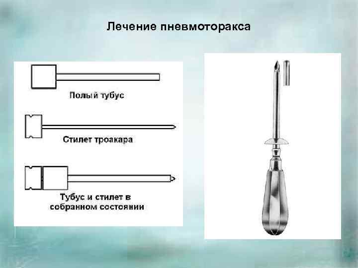 Лечение пневмоторакса 