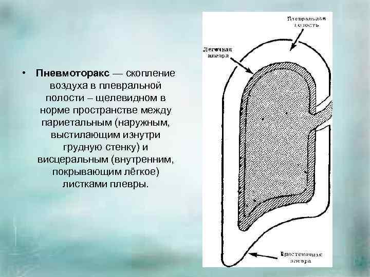  • Пневмоторакс — скопление воздуха в плевральной полости – щелевидном в норме пространстве