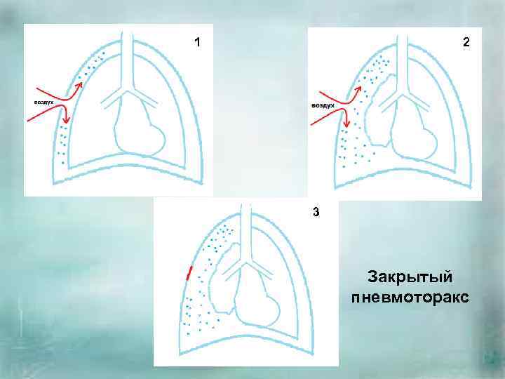 1 1 2 3 Закрытый пневмоторакс 