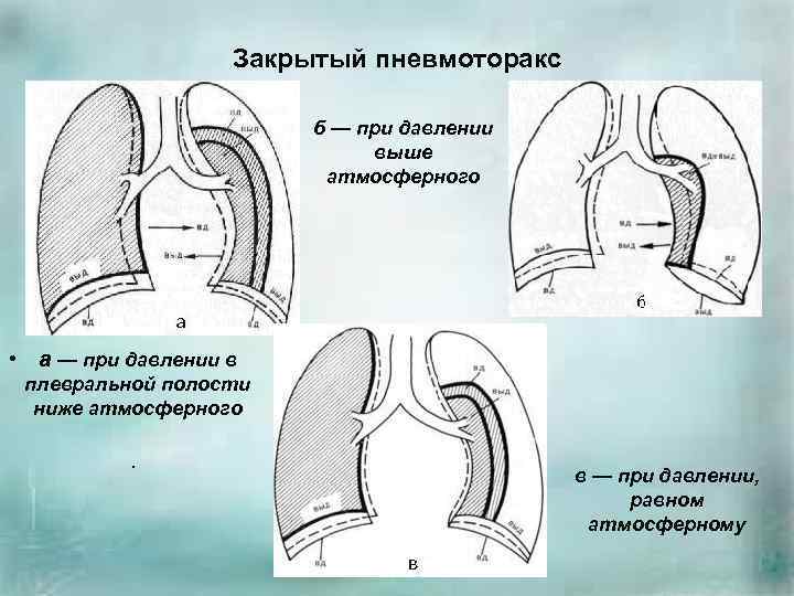 Закрытый пневмоторакс это