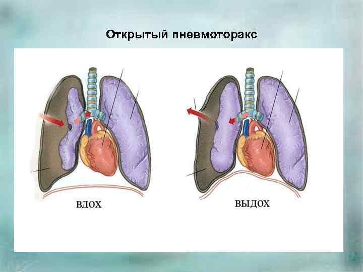 Карта смп пневмоторакс