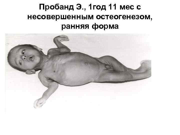 Пробанд Э. , 1 год 11 мес с несовершенным остеогенезом, ранняя форма 