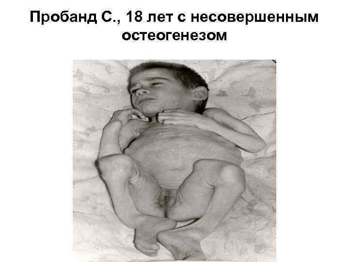 Пробанд С. , 18 лет с несовершенным остеогенезом 