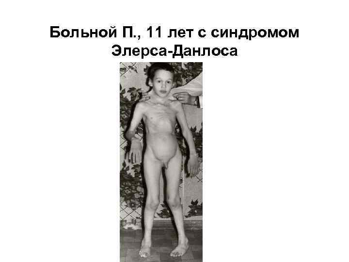 Больной П. , 11 лет с синдромом Элерса-Данлоса 