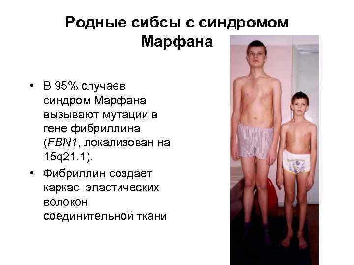 Родные сибсы с синдромом Марфана • В 95% случаев синдром Марфана вызывают мутации в