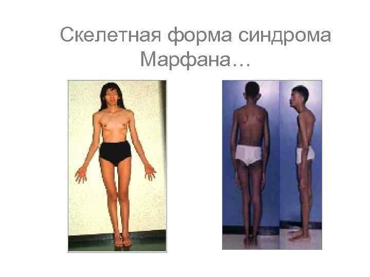 Скелетная форма синдрома Марфана… 