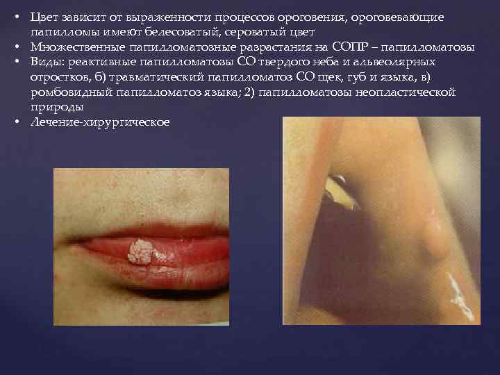  • Цвет зависит от выраженности процессов ороговения, ороговевающие папилломы имеют белесоватый, сероватый цвет