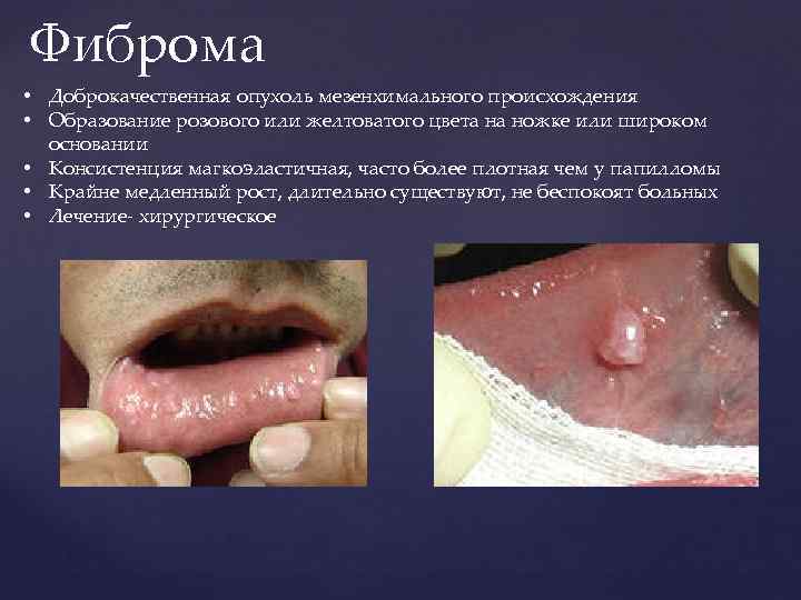 Фиброма • Доброкачественная опухоль мезенхимального происхождения • Образование розового или желтоватого цвета на ножке