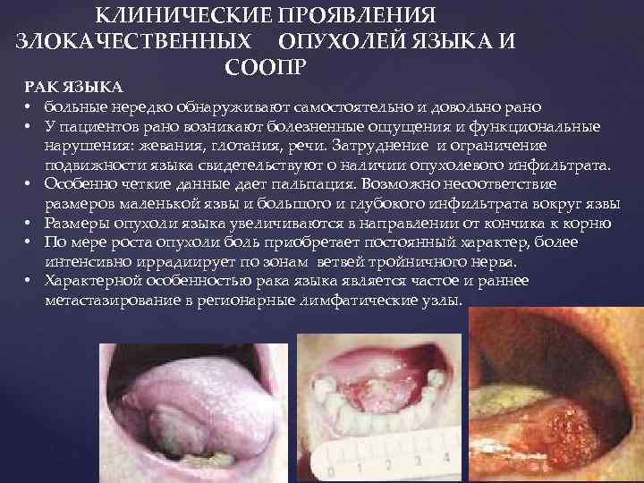 КЛИНИЧЕСКИЕ ПРОЯВЛЕНИЯ ЗЛОКАЧЕСТВЕННЫХ ОПУХОЛЕЙ ЯЗЫКА И СООПР РАК ЯЗЫКА • больные нередко обнаруживают самостоятельно