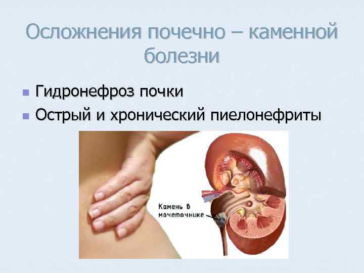 Осложнения почечно – каменной болезни n n Гидронефроз почки Острый и хронический пиелонефриты 