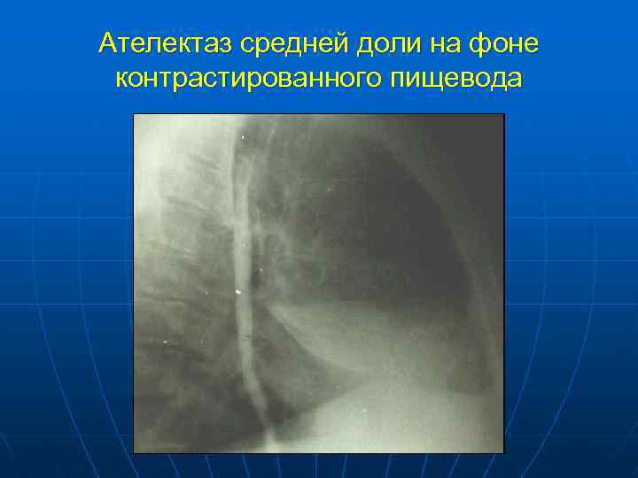Ателектаз средней доли на фоне контрастированного пищевода 