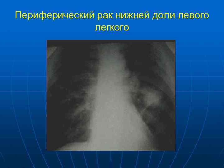 Периферический рак нижней доли левого легкого 