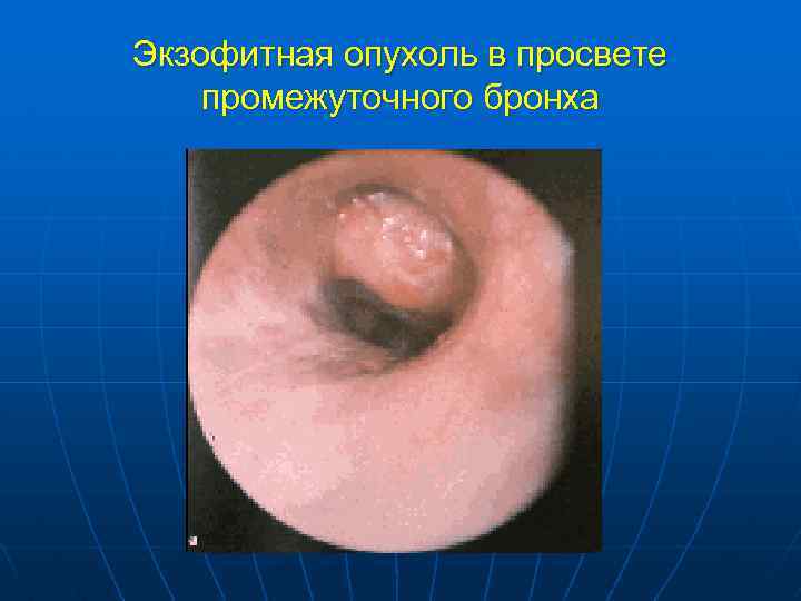 Экзофитная опухоль в просвете промежуточного бронха 