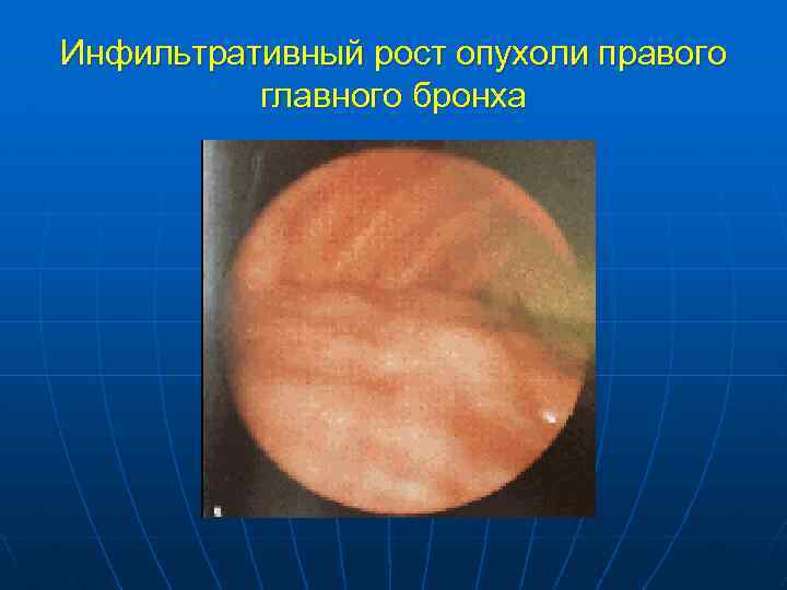 Инфильтративный рост опухоли правого главного бронха 