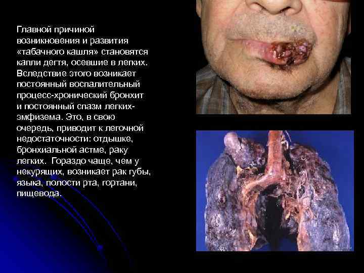 Главной причиной возникновения и развития «табачного кашля» становятся капли дегтя, осевшие в легких. Вследствие