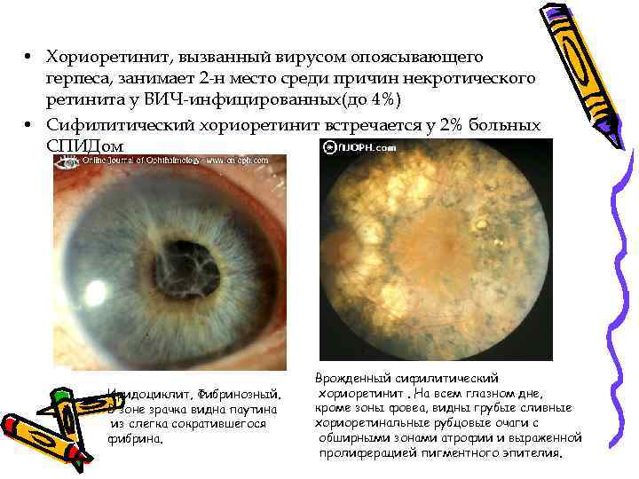 • Хориоретинит, вызванный вирусом опоясывающего герпеса, занимает 2 -н место среди причин некротического