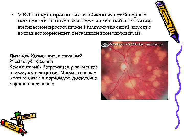  • У ВИЧ-инфицированных ослабленных детей первых месяцев жизни на фоне интерстициальной пневмонии, вызываемой