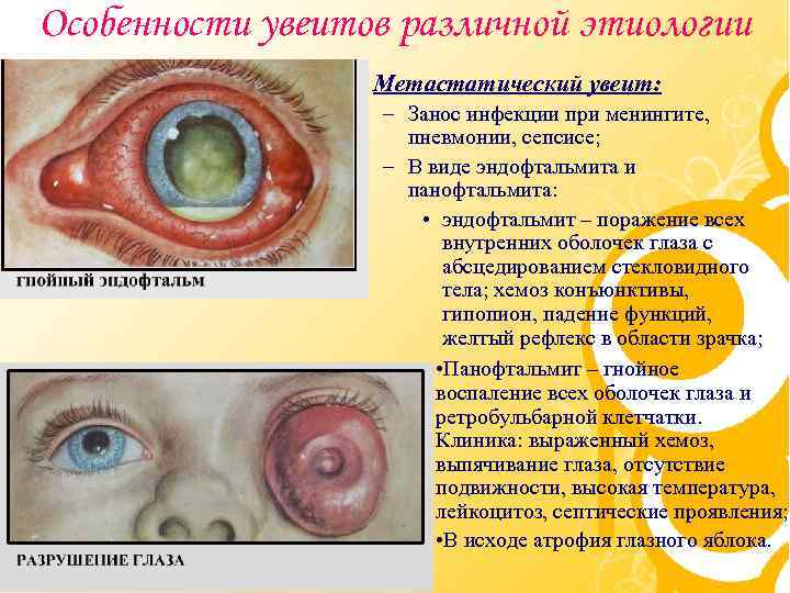 Особенности увеитов различной этиологии • Метастатический увеит: – Занос инфекции при менингите, пневмонии, сепсисе;