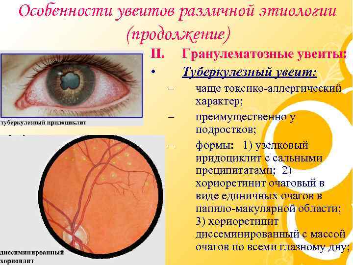 Особенности увеитов различной этиологии (продолжение) II. • Гранулематозные увеиты: Туберкулезный увеит: – – –