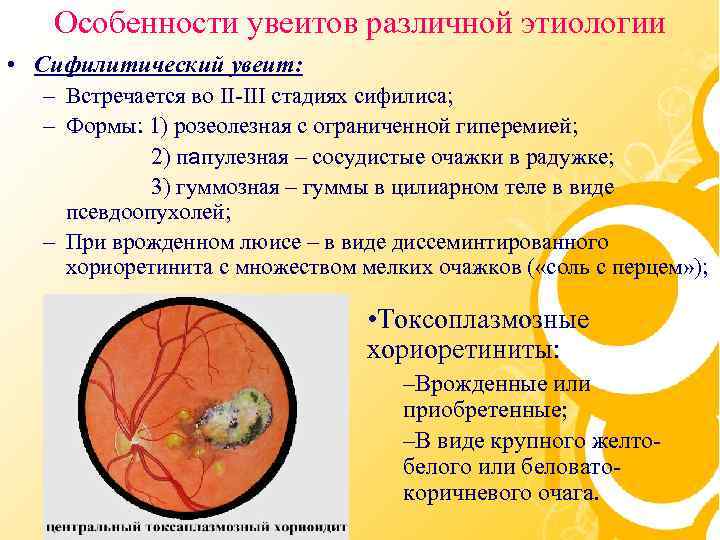 Особенности увеитов различной этиологии • Сифилитический увеит: – Встречается во II-III стадиях сифилиса; –