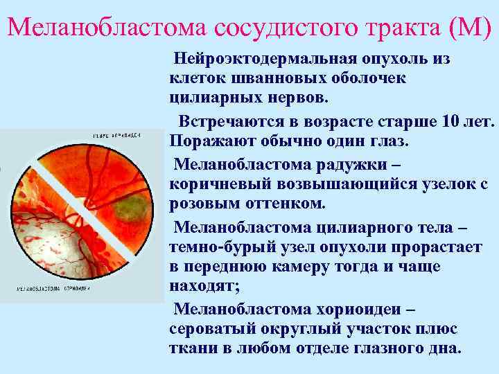 Меланобластома сосудистого тракта (М) Нейроэктодермальная опухоль из клеток шванновых оболочек цилиарных нервов. Встречаются в