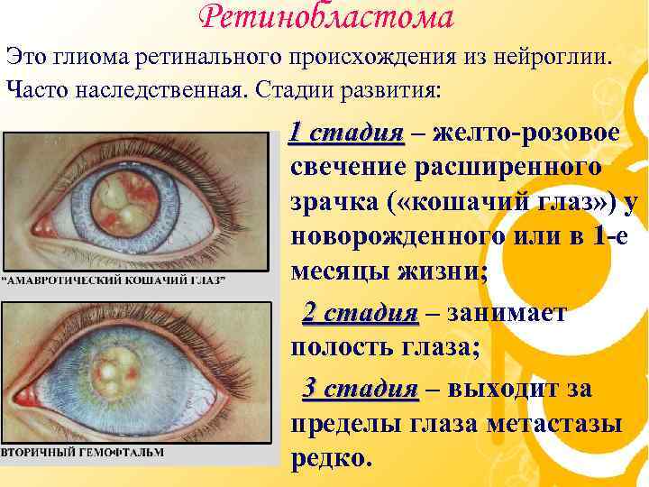 Ретинобластома Это глиома ретинального происхождения из нейроглии. Часто наследственная. Стадии развития: 1 стадия –