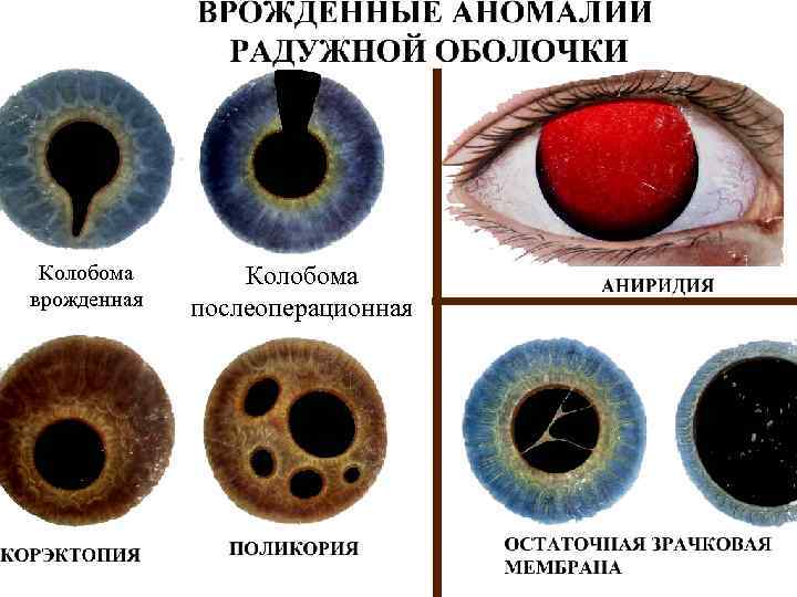 Аномалии сосудистой оболочки • Аниридия – отсутствие радужки. • Колабома сосудистой – дефект, отсутствие