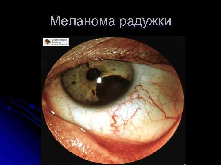 Меланома радужки 