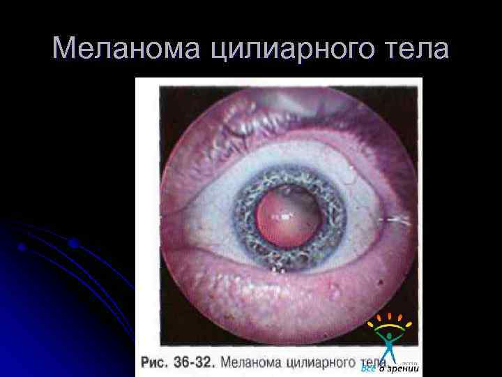 Меланома цилиарного тела 