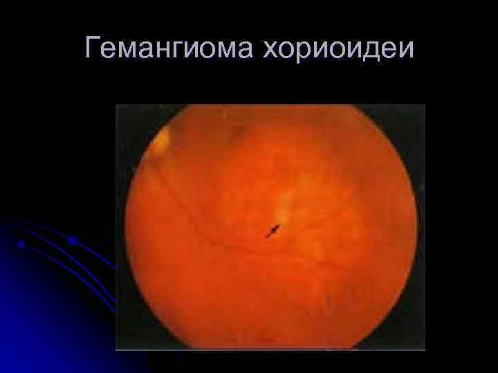 Гемангиома хориоидеи 